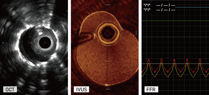 IVUS